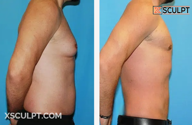 Grade 3 Gynecomastia Before After Photos 7 Screenshot 2024 11 19 230807