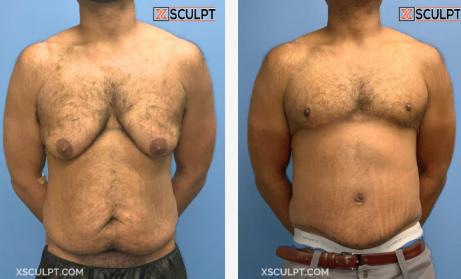 Grade 4 Gynecomastia Before After Photos 1 Screenshot 2024 11 20 214623 1