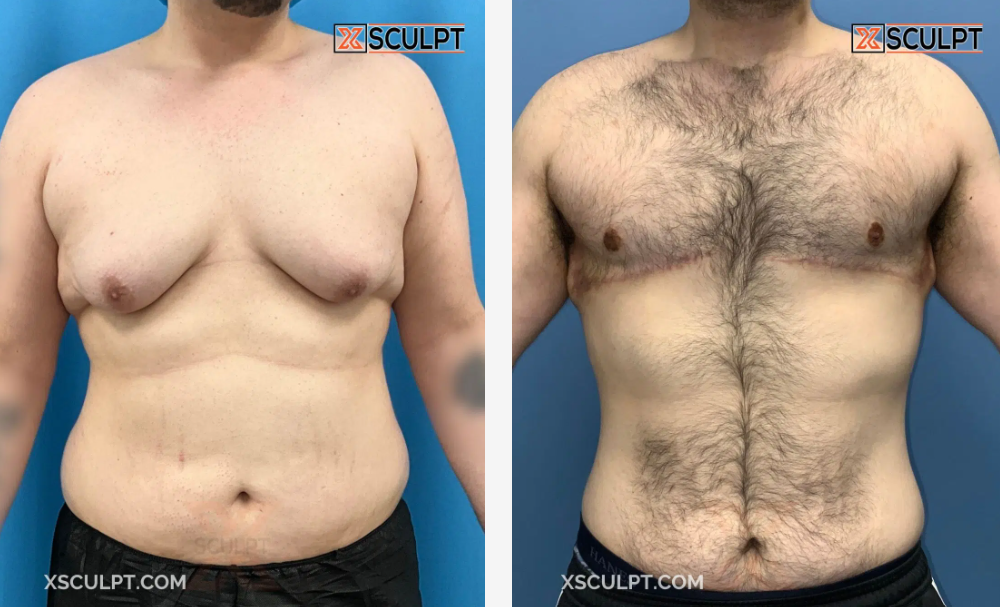 Grade 4 Gynecomastia Before After Photos 2 Screenshot 2024 11 20 215241