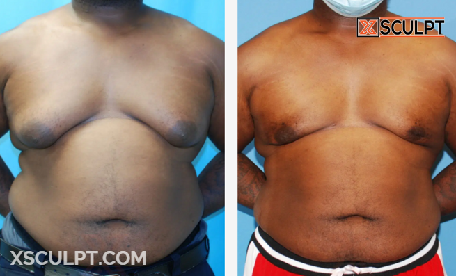 Grade 4 Gynecomastia Before After Photos 4 Screenshot 2024 11 20 215942