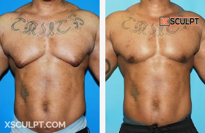 Grade 4 Gynecomastia Before After Photos 5 Screenshot 2024 11 20 220402