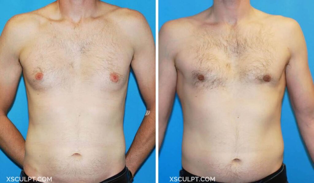 Grade 1 gynecomastia before after photo 62