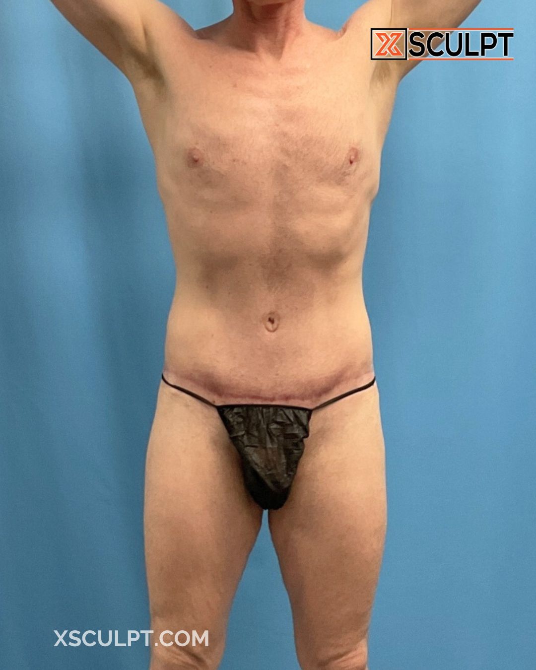 Xsculpt Male Surgery