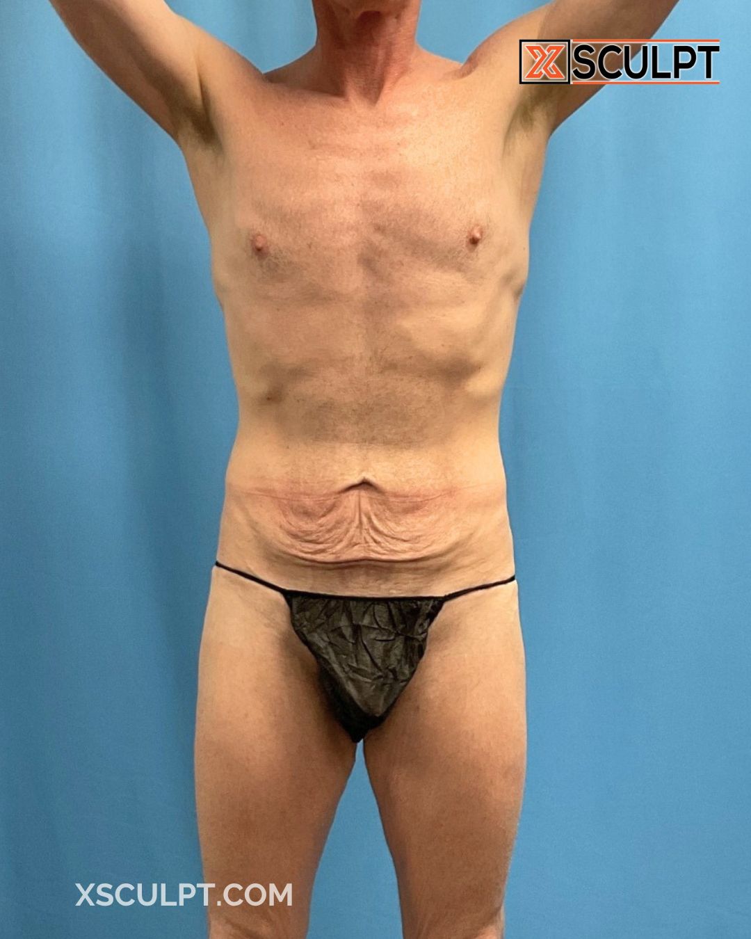 Xsculpt Male Surgery