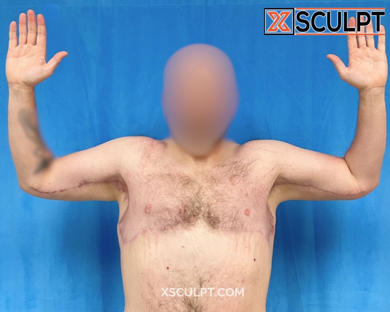 Xsculpt Male Surgery