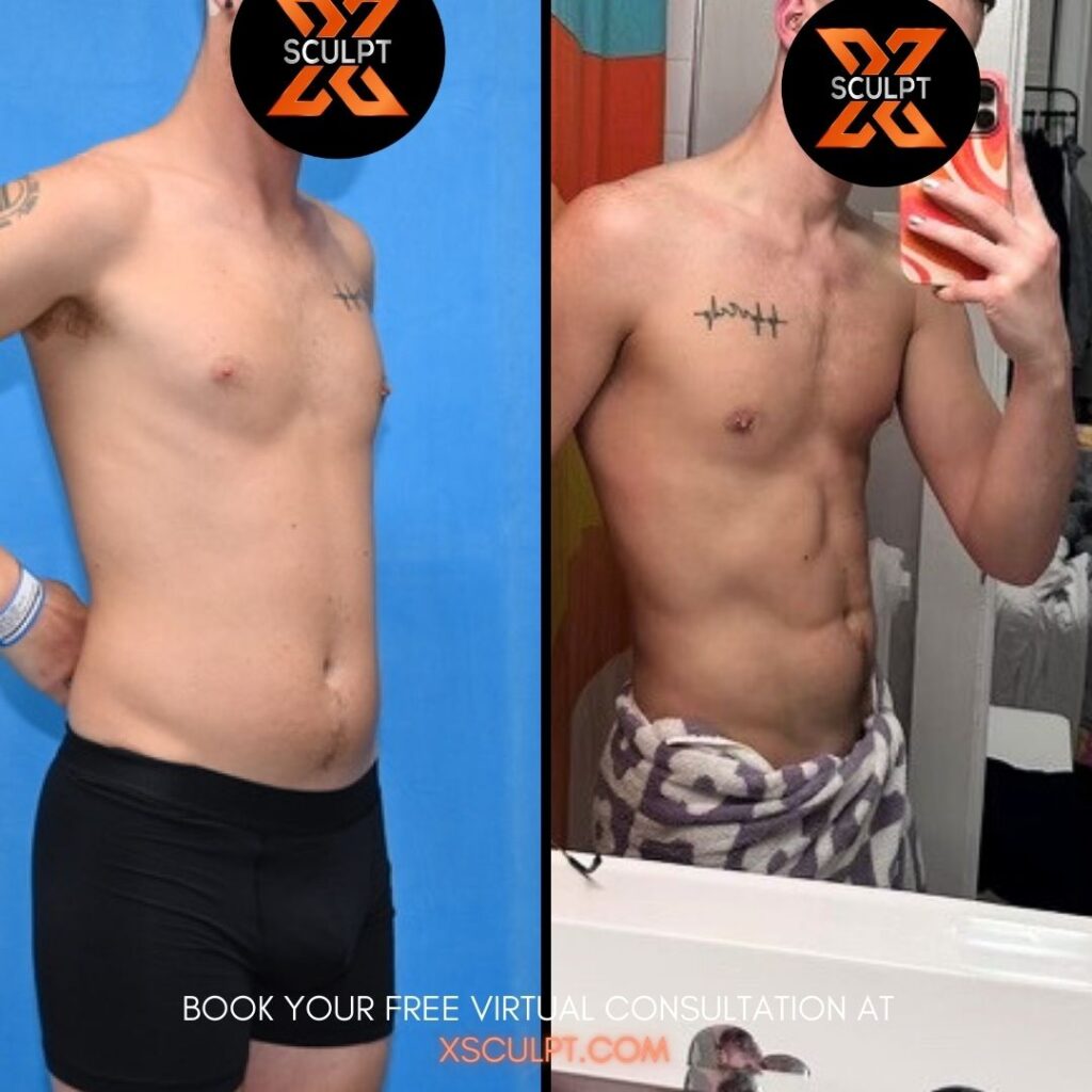 Before and after photo of patient treated with Hi Def VASER lipo at XSculpt in Chicago