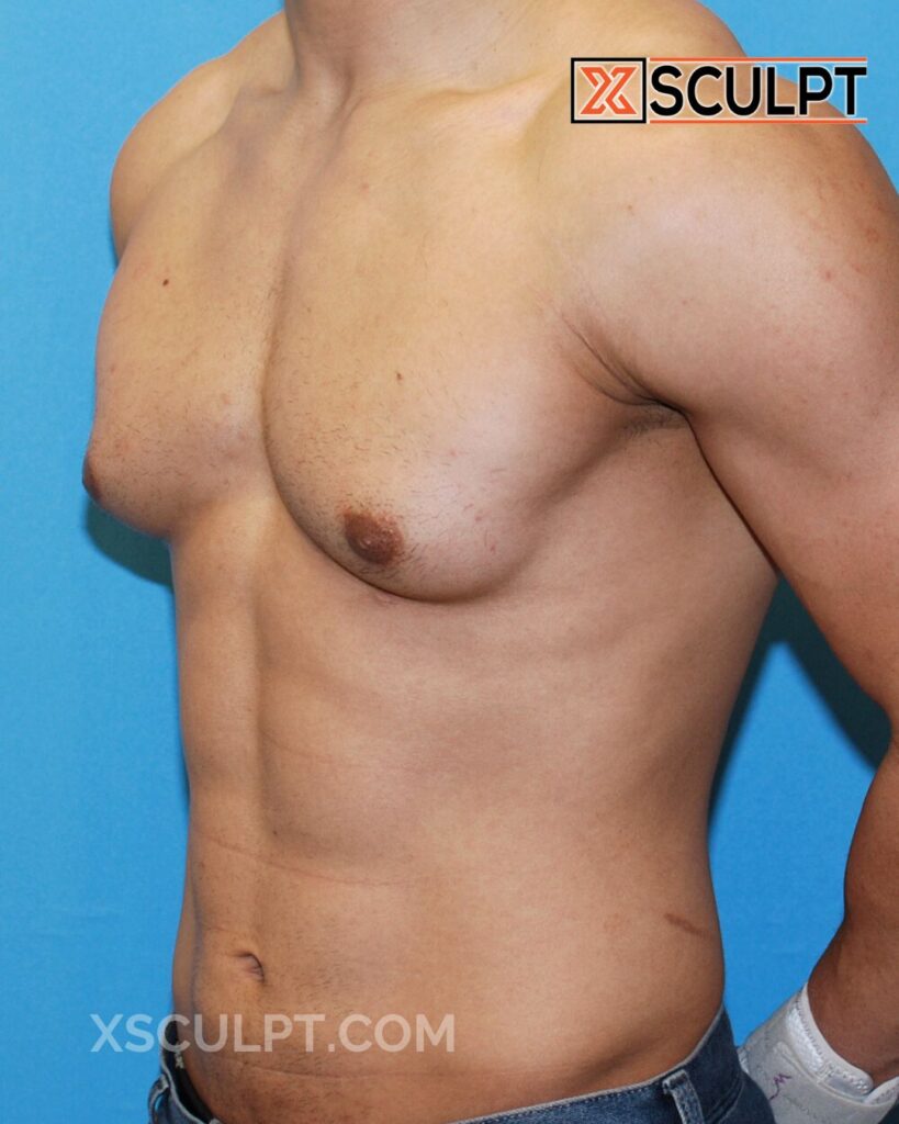 43000 bodybuilder steroid gynecomastia by dr. Anh tuan truong xsculpt chicago