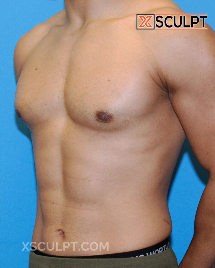 43000 bodybuilder steroid gynecomastia by dr. Anh tuan truong xsculpt chicago