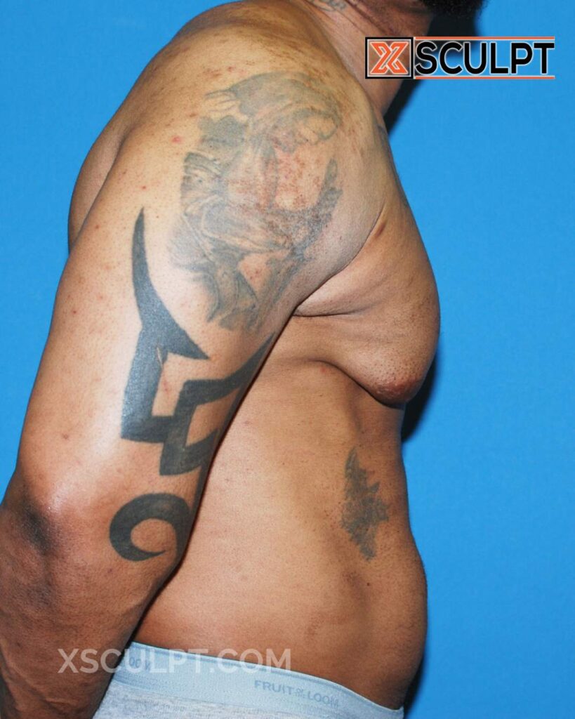 Bodybuilder gynecomastia grade 4 before after photos by dr. Anh tuan truong xsculpt chicago 57000