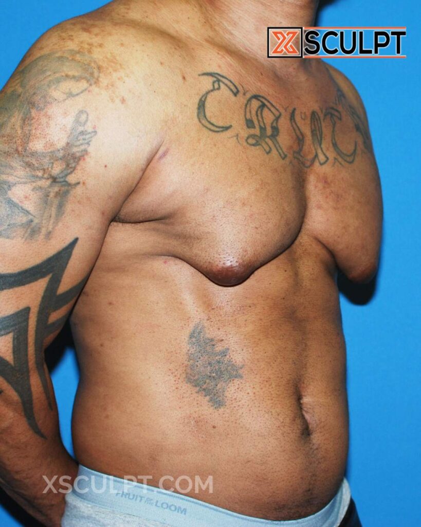 Bodybuilder gynecomastia grade 4 before after photos by dr. Anh tuan truong xsculpt chicago 57000