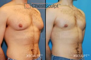 Does gynecomastia cause nipple discharge?