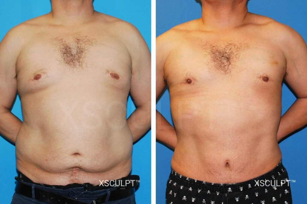 Male tummy tuck before after photo 1149629 xsculpt 2