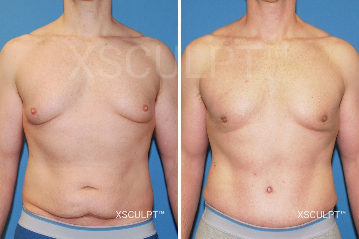 male tummy tuck before after photo chicago xsculpt