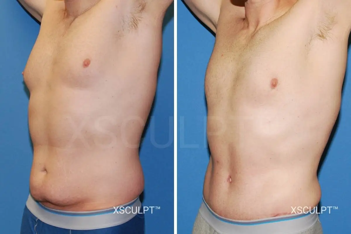 Male tummy tuck before and after photos xsculpt chicago 2