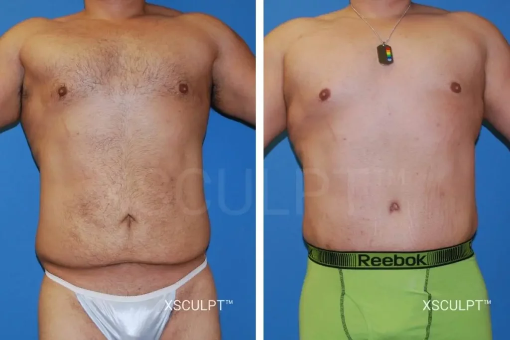 Male tummy tuck before after photo xsculpt chicago