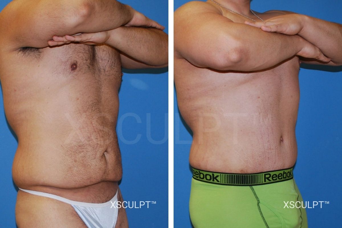 tummy tuck for men before after photo xsculpt chicago
