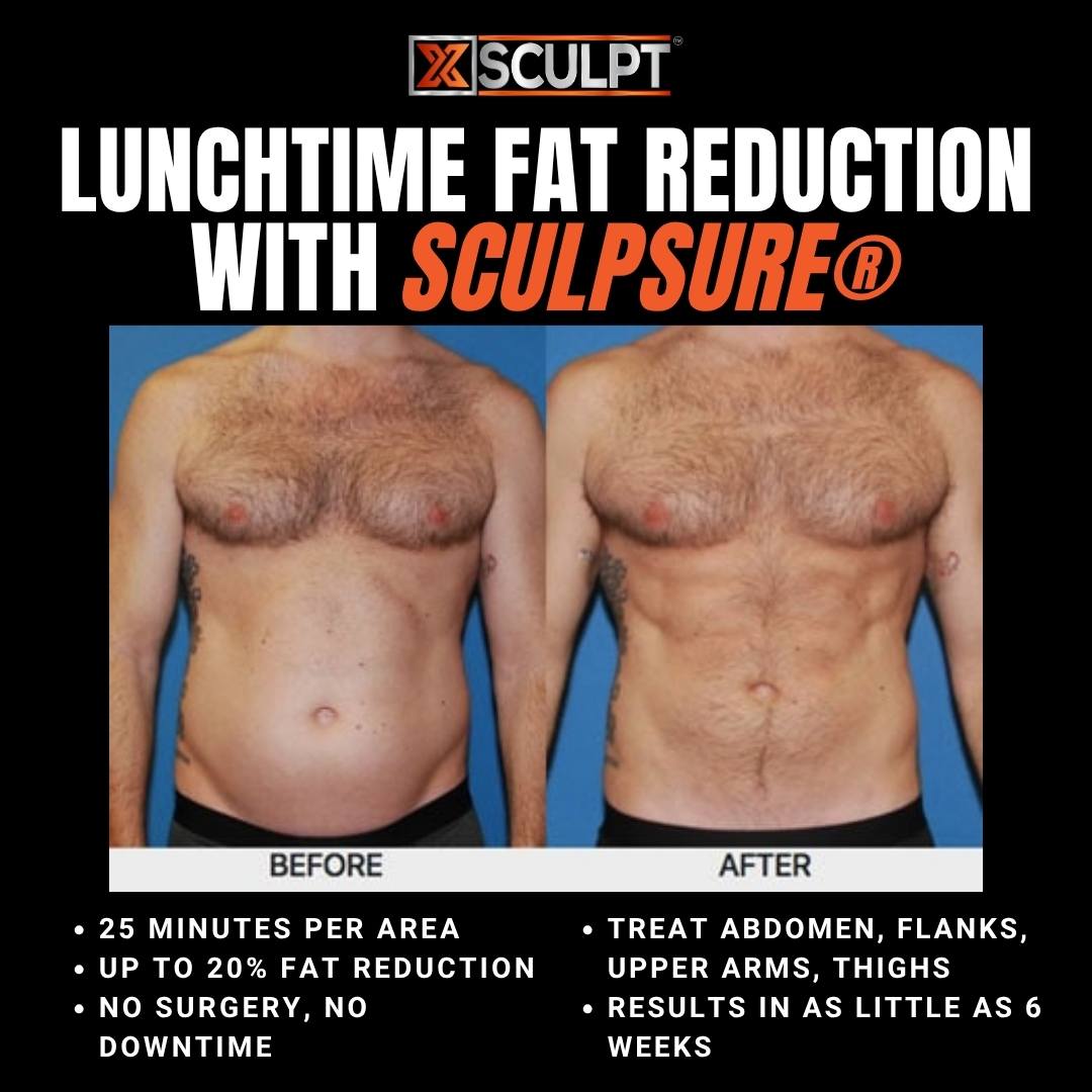 non-surgical fat removal chicago xsculpt