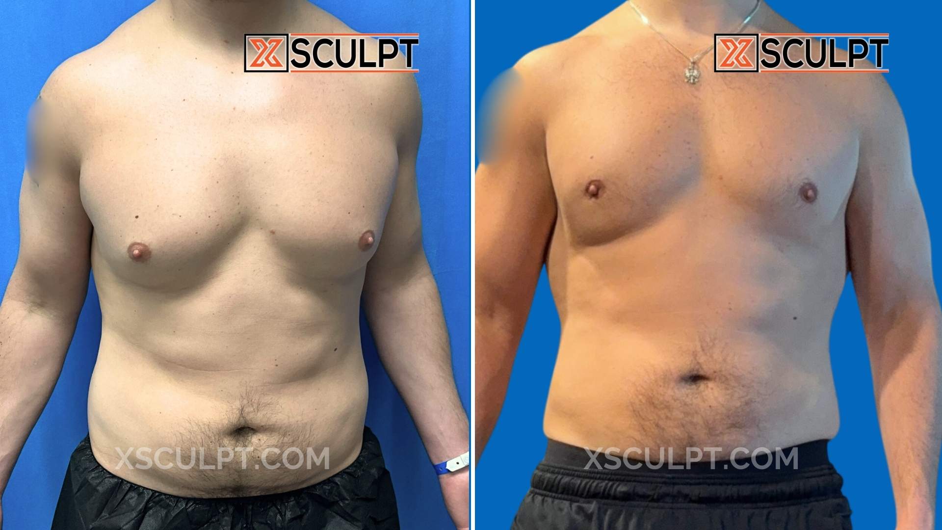 2349060 Grade 2 Gyno Before After Chestsculpt By Dr. Marc Adajar Xsculpt Chicago 3 months