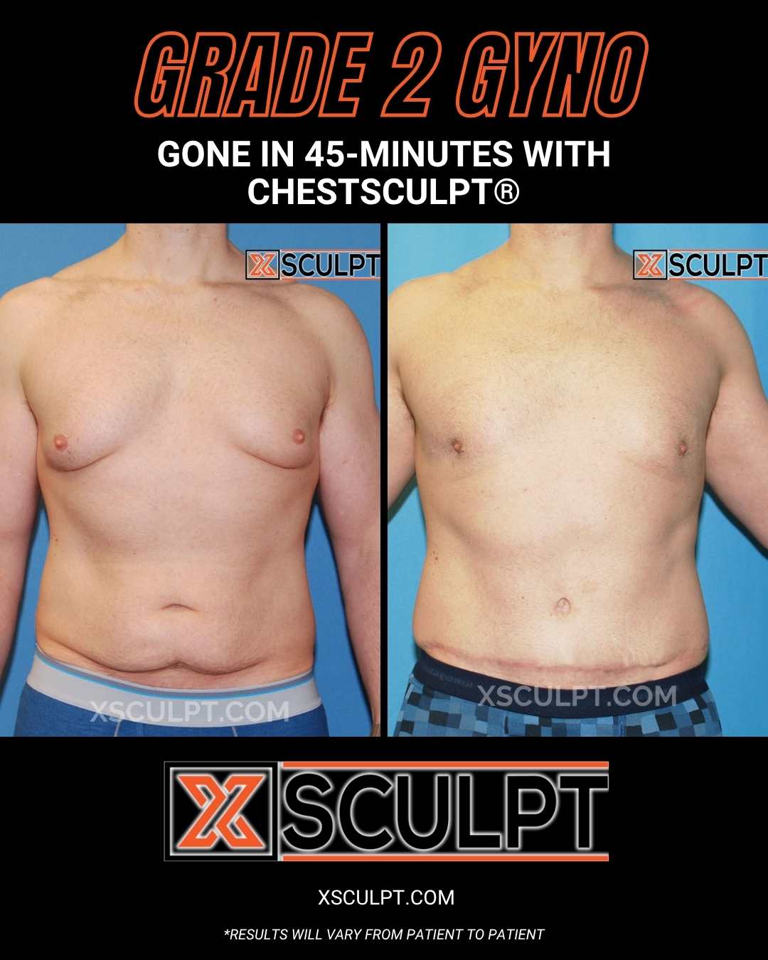 grade 2 gyno before after by xsculpt chicago (1)