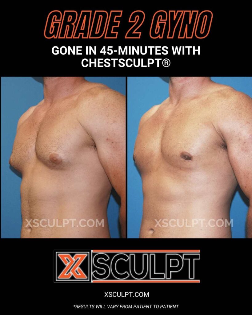 Gynecomastia Stages: Grade 1 Through Grade 4 Explained 2 grade 2 gyno before after by xsculpt chicago