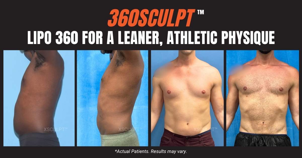 Specials | Plastic Surgery Special Pricing in Chicago 4 360sculpt male liposuction 360 xsculpt chicago