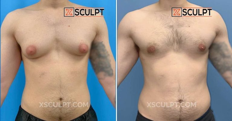 Grade 3 Gynecomastia Before After Photos 10 Gynecomastia Before after photo by Dr. Marc Adajar Chicago 1881367