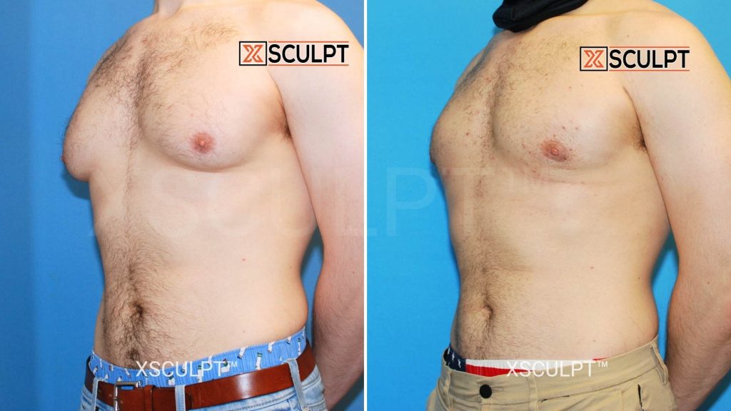 gynecomastia before after photo by dr. marc adajar 1540411