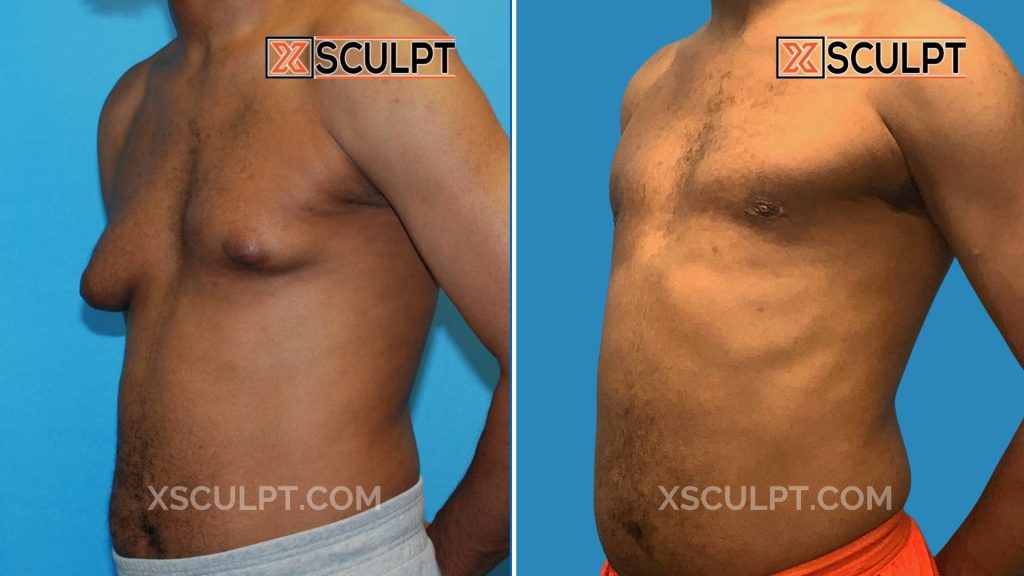Grade 3 Gynecomastia Before After Photos 3 Chicago gynecomastia grade 3 results, male chest reduction before and after by Dr. Marc Adajar at XSculpt
