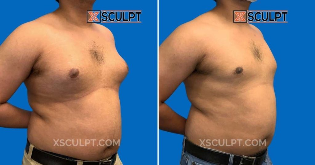 Grade 3 Gynecomastia Before After Photos 2 Male Breast Reduction Before After 6 mo By Dr. Marc Adajar Xsculpt Chicago 1744352