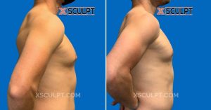 Male Nipple Reduction Before After 6 mo By Dr. Marc Adajar Xsculpt Chicago 1780208 