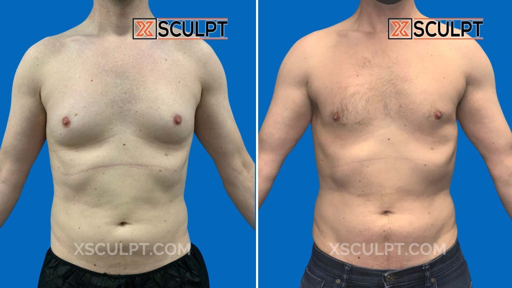 Chicago gynecomastia grade 3 results, male chest reduction before and after by Dr. Marc Adajar at XSculpt 1807836