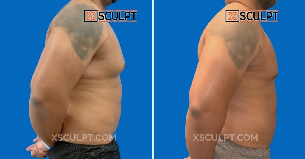 Can Gynecomastia Come Back After Surgery? 2 1994630 Grade 2 Gynecomastia Dr. Adajar Chicago 1mo