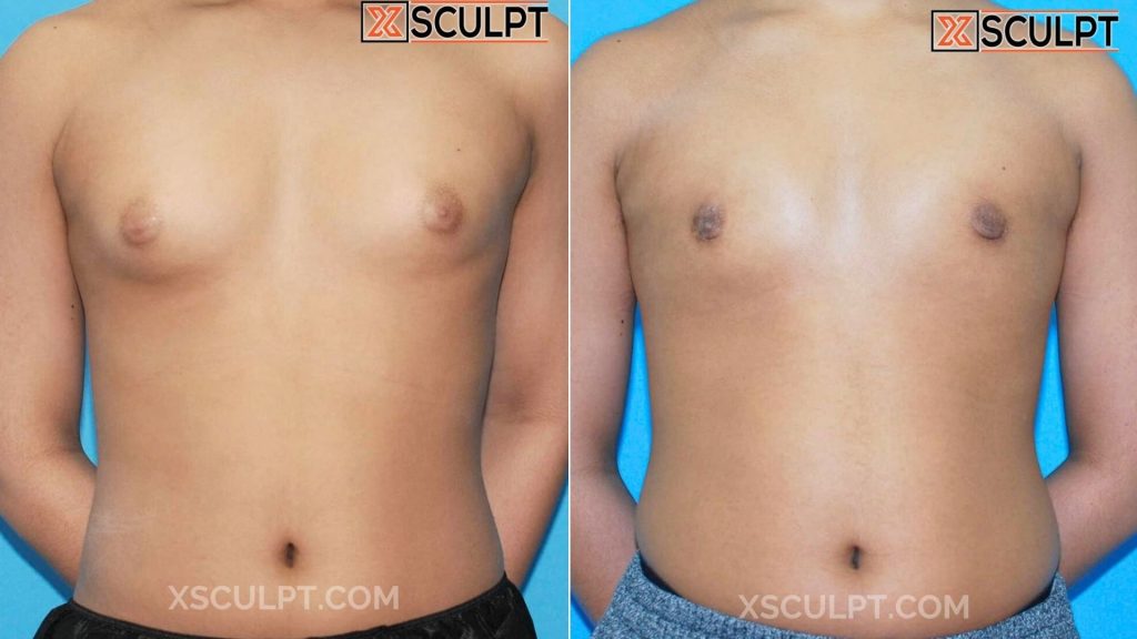 Can Gynecomastia Come Back After Surgery? 1 51 Grade 2 Gynecomastia Dr. Truong Chicago 1mo