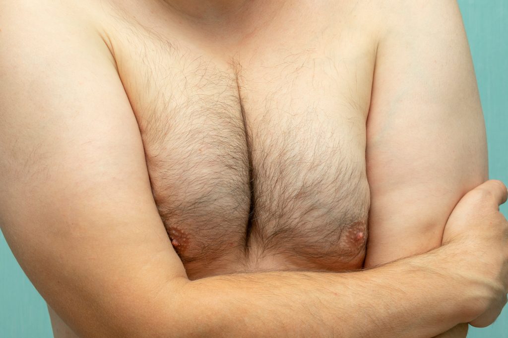 Estrogen Blockers for Gynecomastia: Do They Actually Work? 1 AdobeStock 228309859