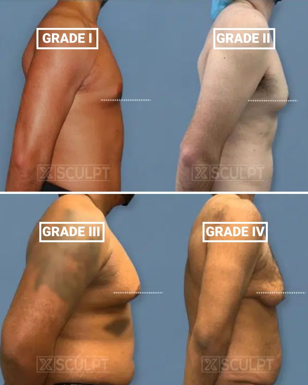 Gynecomastia Stages: Grade 1 Through Grade 4 Explained 1 gyno grades