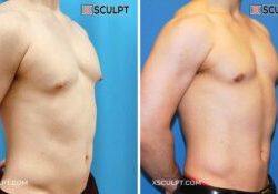 Before and After Puffy Nipple Grade 1 Gynecomastia Photo by XSculpt