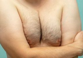 fat white middle-aged man with Gynecomastia, enlarged breast